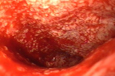 Colorectal leakage cavity after 11 days