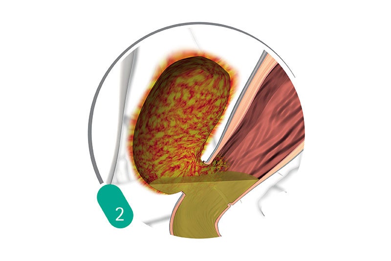 Treatment Procedure