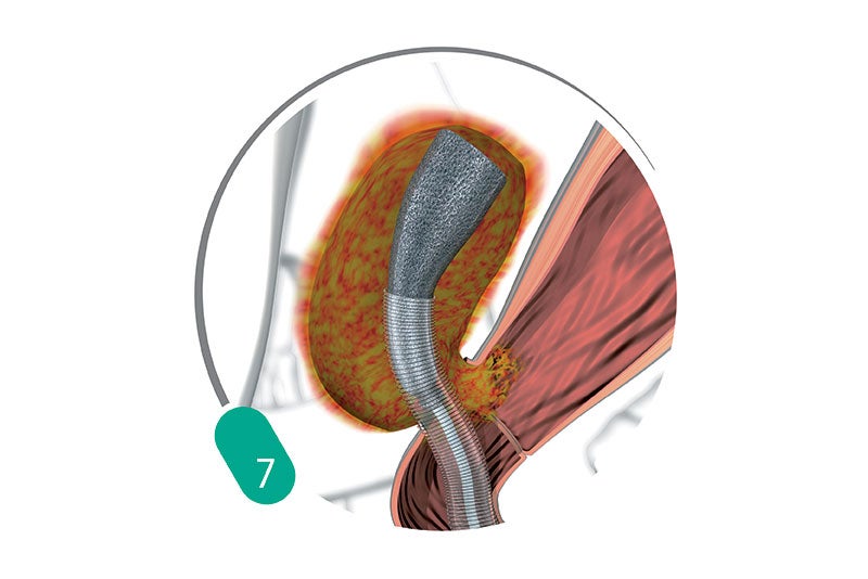 Treatment Procedure