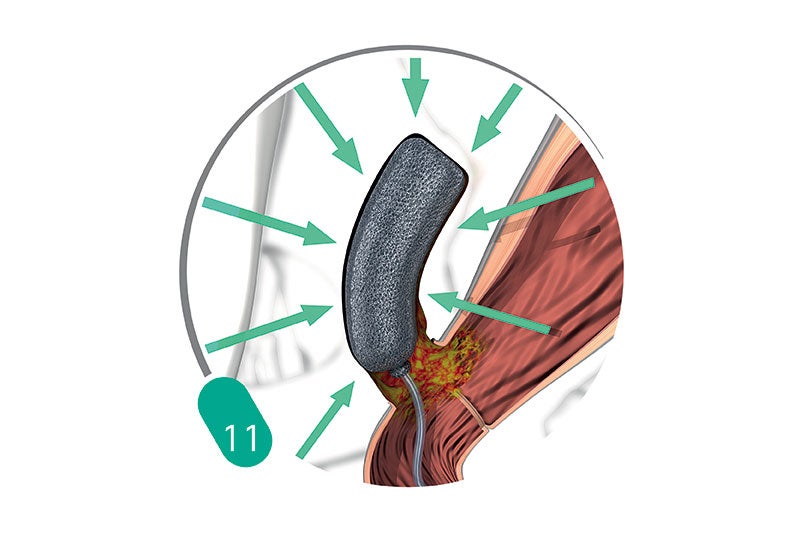 Treatment Procedure