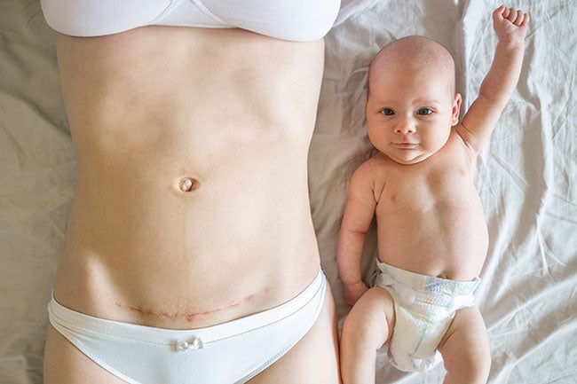 Closeup of woman belly with a scar from a cesarean section and her baby with raised hand near