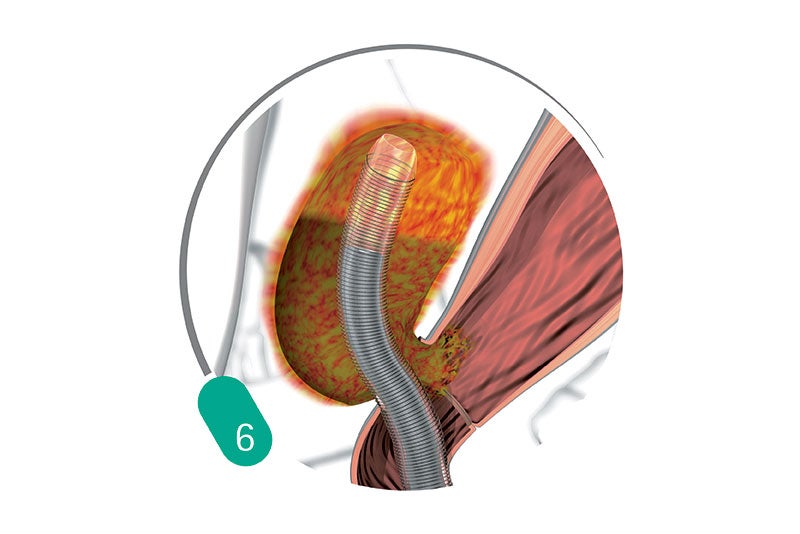 Treatment Procedure