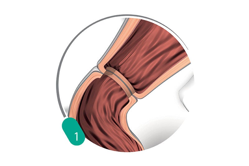 Treatment Procedure